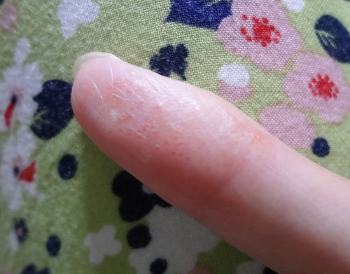 指の湿疹